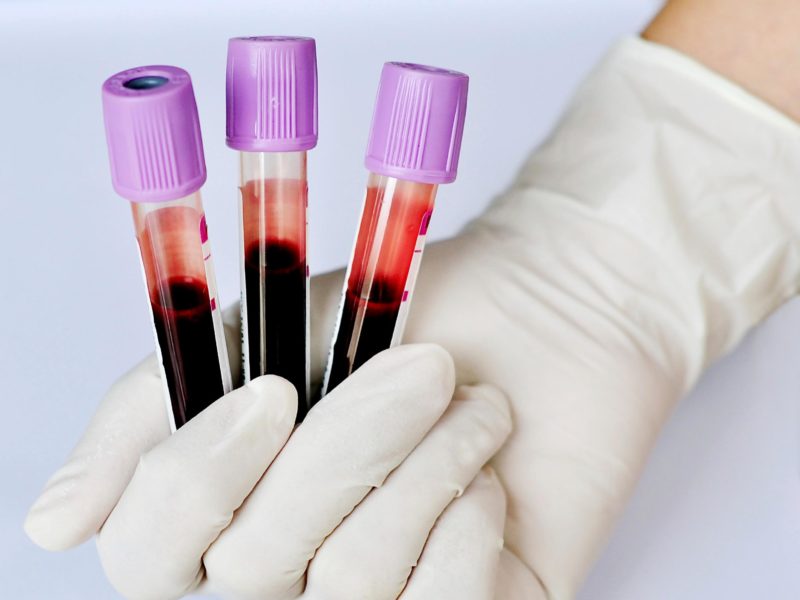 Моноцити в аналізі крові: коли вони можуть бути підвищені